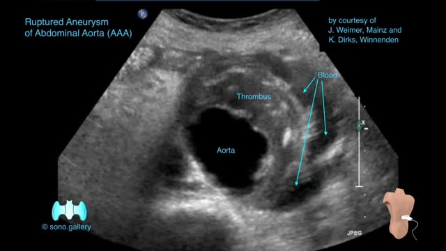 Ruptured Aneurysm of Abdominal Aorta (AAA)