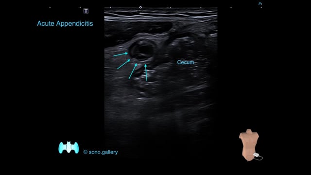 Acute Appendicitis