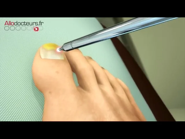 Laser de nettoyage des champignons des ongles pour onychomycose, outil  révolutionnaire à usage domestique pour les ongles des doigts et des  orteils : : Santé et Soins personnels