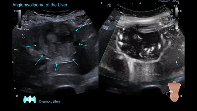 Angiomyolipoma of the Liver