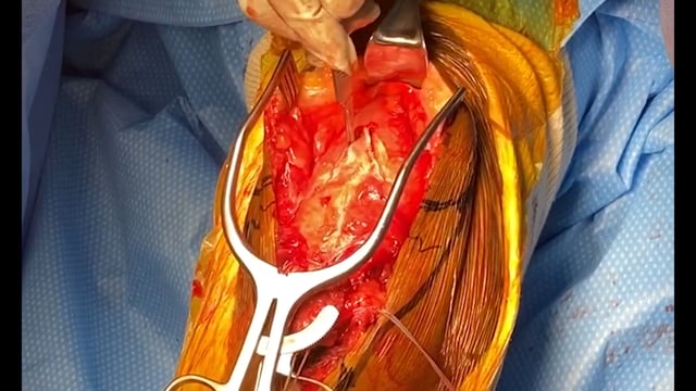 Primary Patella Tendon Repair with V-Y Quadricepsplasty