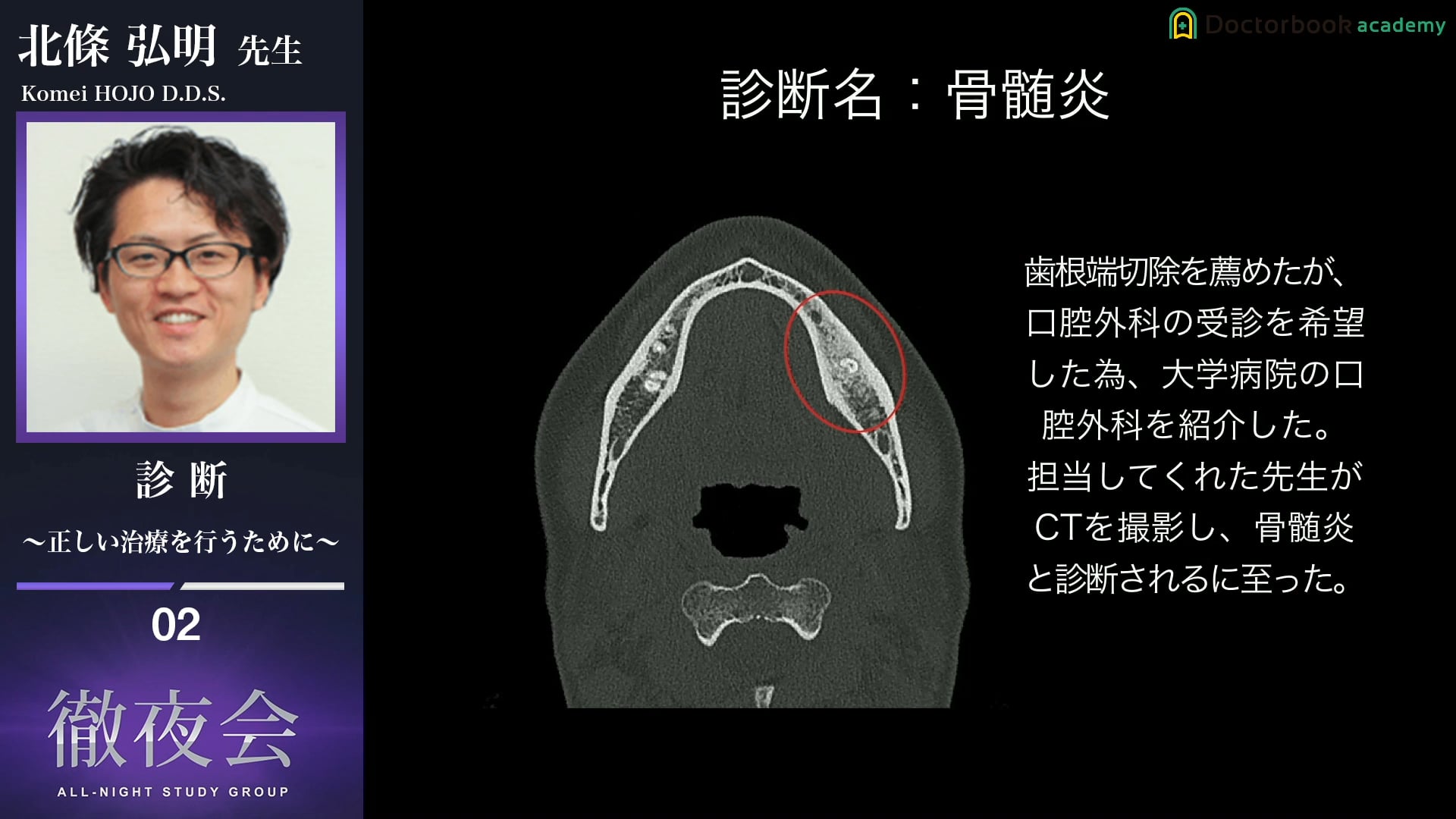 #2 失活歯の診断