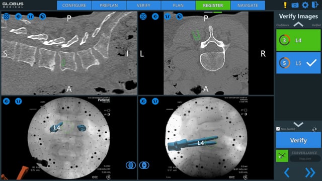 Minimally Invasive Surgical (MIS) Transforaminal Lumbar Interbody Fusion (TLIF)