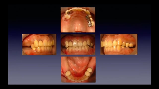 #3 Denture Cafe 第14回「矯正治療と全部床義歯臨床の共通点と相違点」〜異分野との対話から学ぶ〜