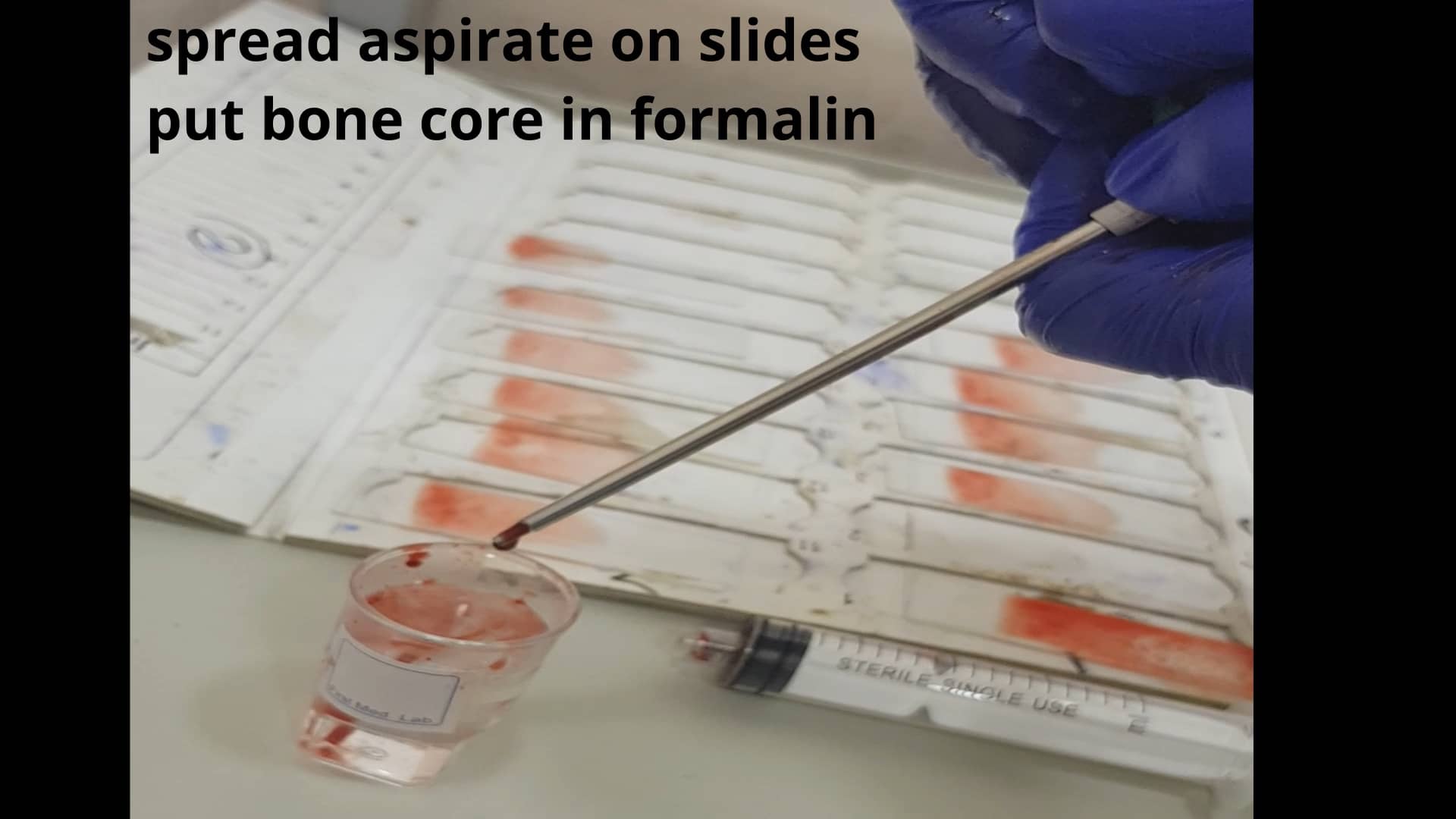bone-marrow-aspiration-and-biopsy-procedure-on-vimeo