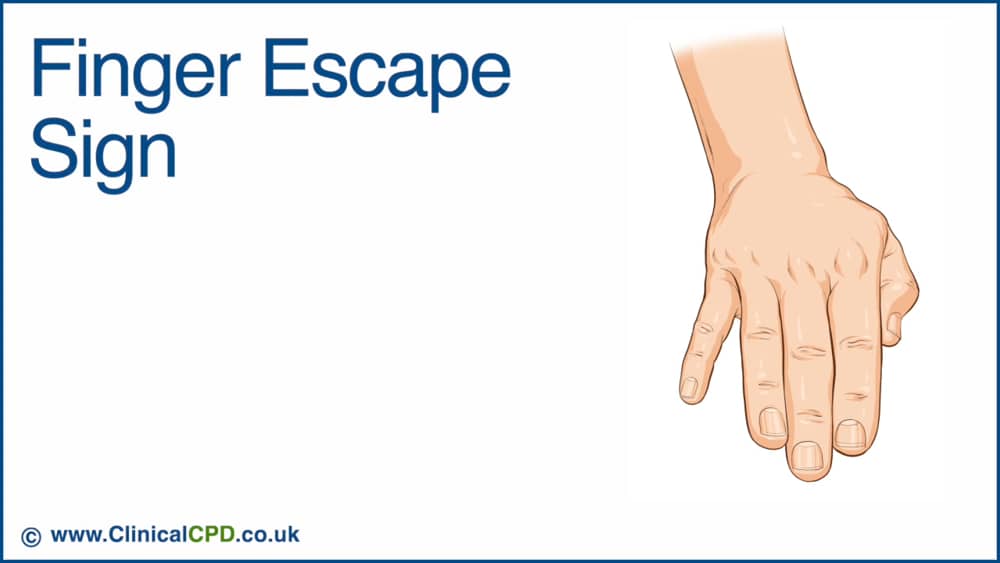 Video Finger Escape Sign Clinical Cpd Co Uk