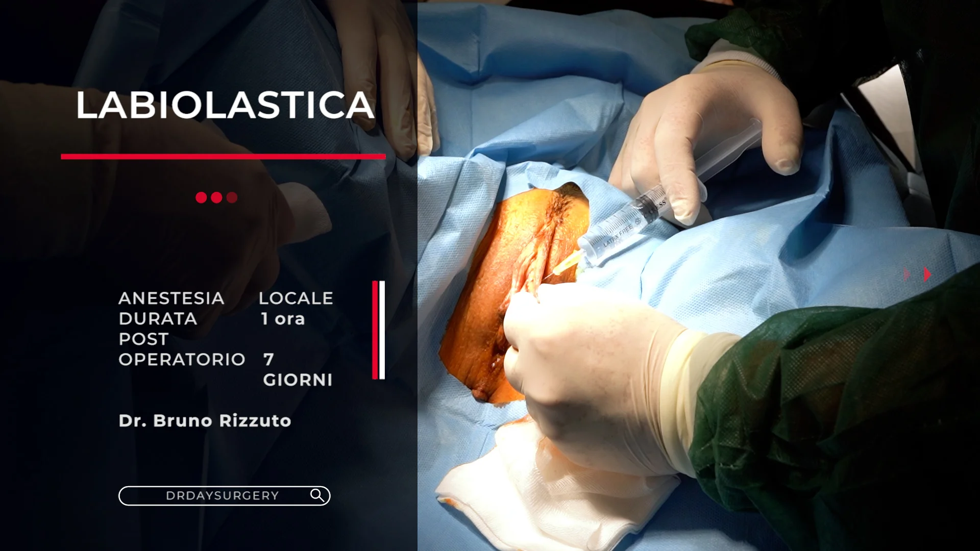 LABIOPLASTICA - Intervento di Chirurgia Estetica Intima  