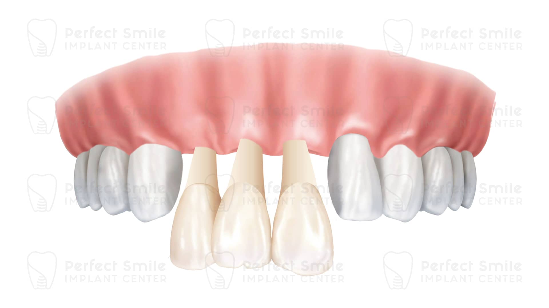 multiple-implants-watermark-dentist-in-tijuana-tijuana-dentistry