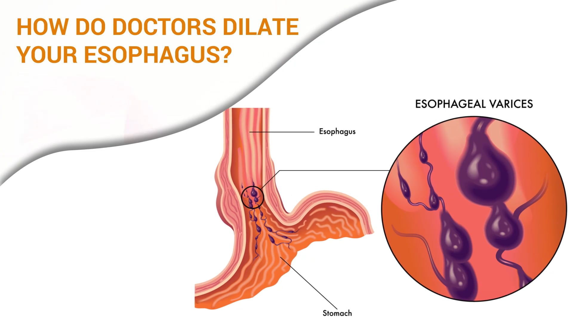 how-do-doctors-dilate-your-esophagus-on-vimeo