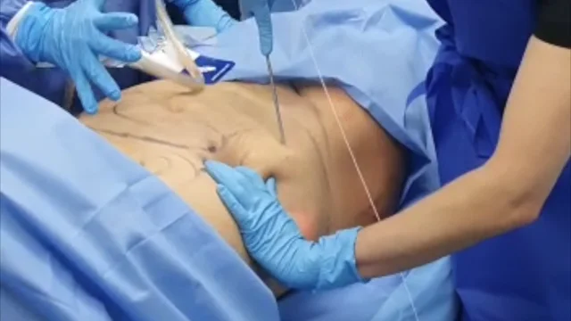 Pearls of Wisdom: Abdominal, Waist and Back Lipo Incisions - Avellanet  Surgical Aesthetics