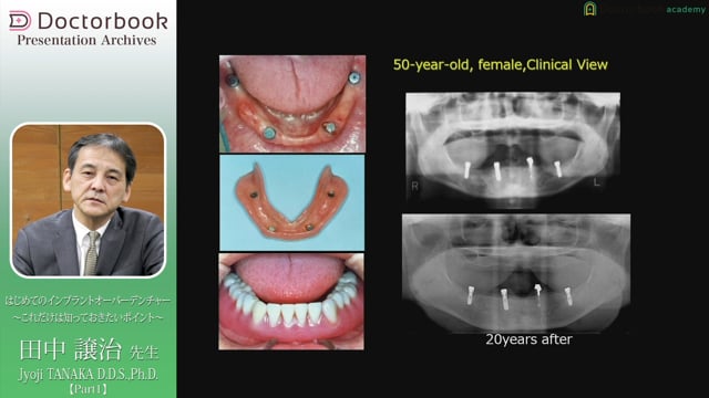 はじめてのインプラントオーバーデンチャー 〜これだけは知っておきたいポイント〜