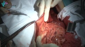 Biopsia intestinal