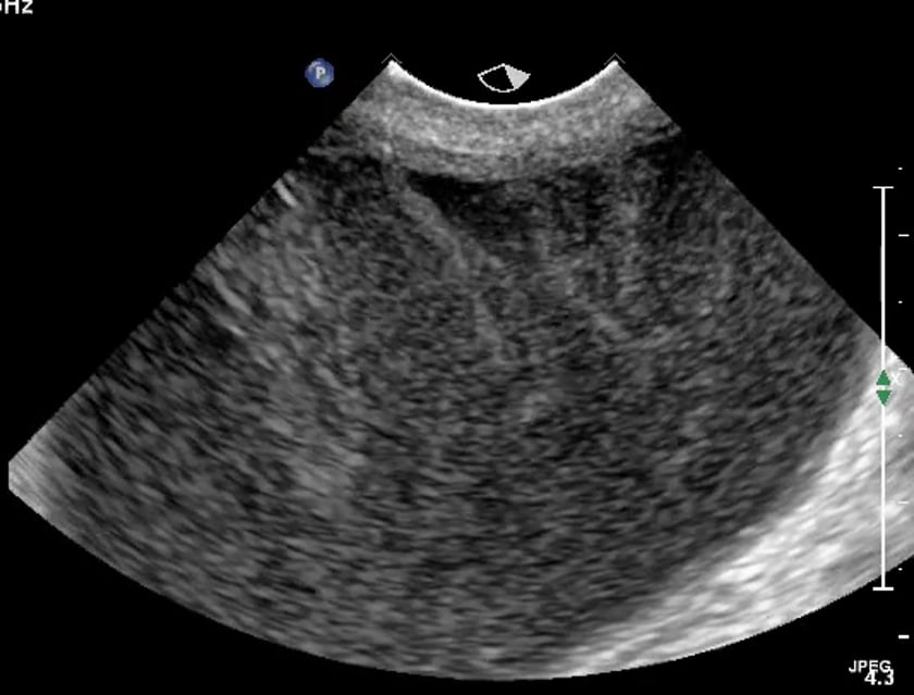 ovarian yolk sac tumor ultrasound