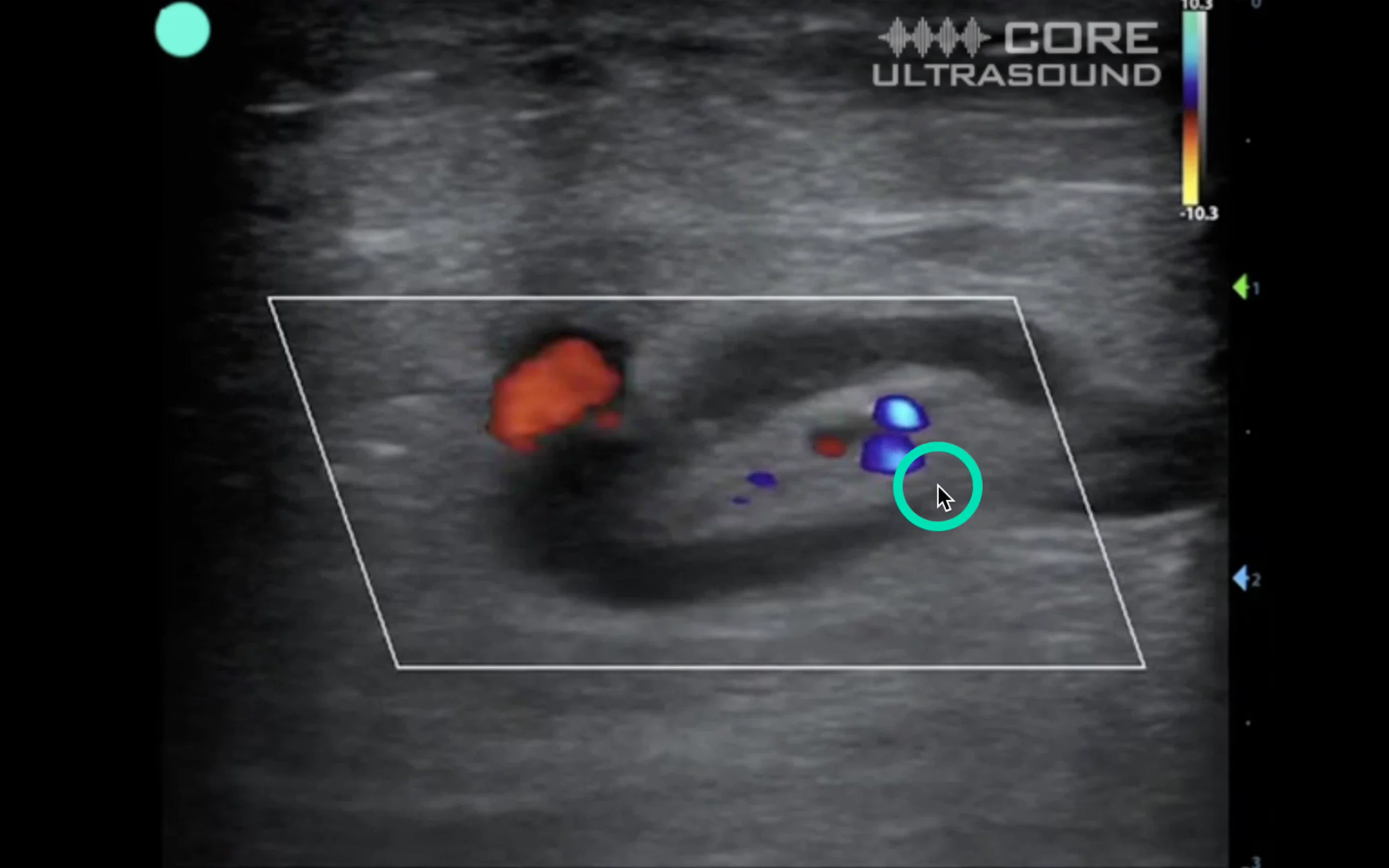 Groin Lymph Node False Positive DVT.mp4