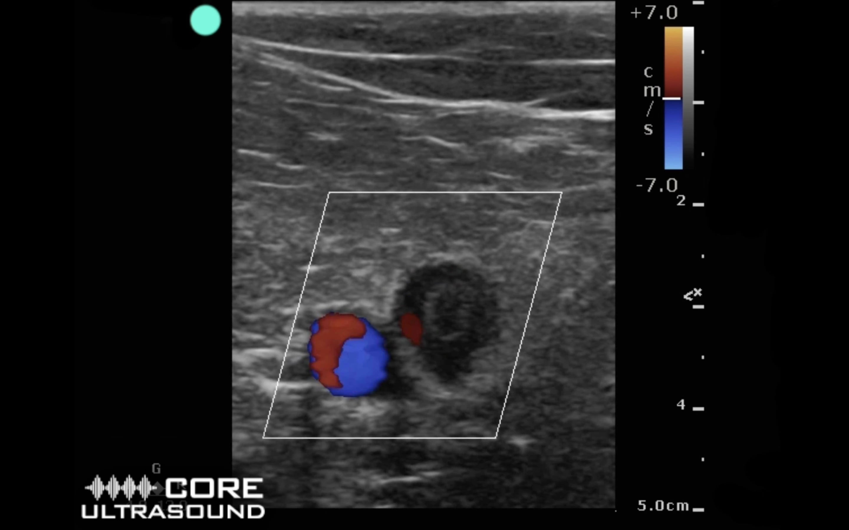 Popliteal DVT with Color Doppler.mp4 on Vimeo