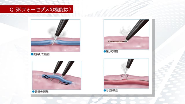 SKフォーセプスを活用した眼瞼下垂手術