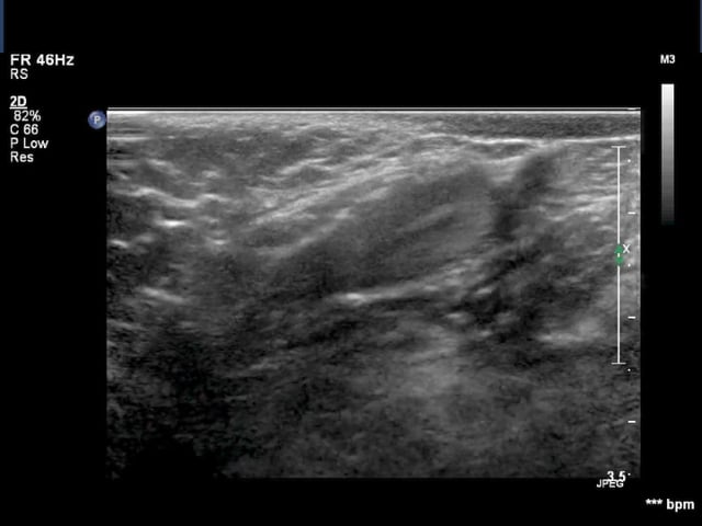 Scrotum pathology – ULTRASOUNDPAEDIA