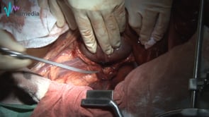 Nefrectomía -  Ureteronefrectomía