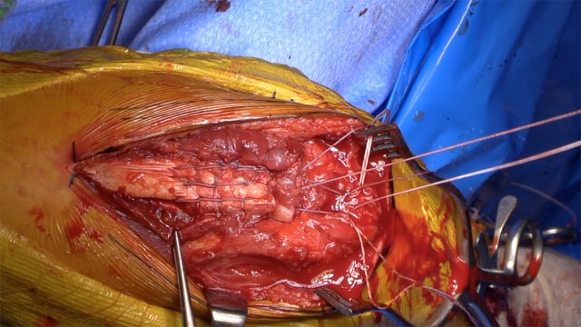 Distal Triceps Tendon Rupture Repair