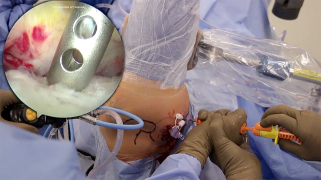 Revision Arthroscopic Bankart Repair for Traumatic Anterior Shoulder Instability