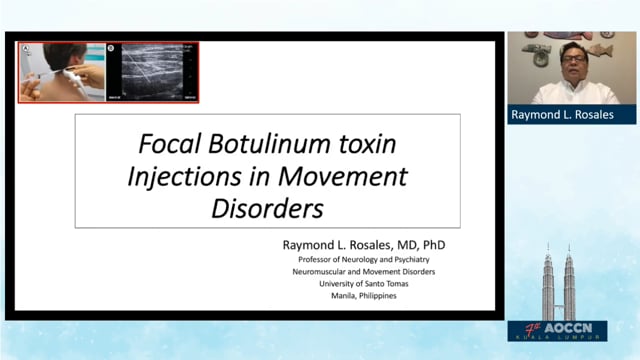 Focal Botulinum Toxin Injections in Movement Disorders