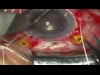 Gortex Suture for ABK pre-DSEK - Large 540p.mov