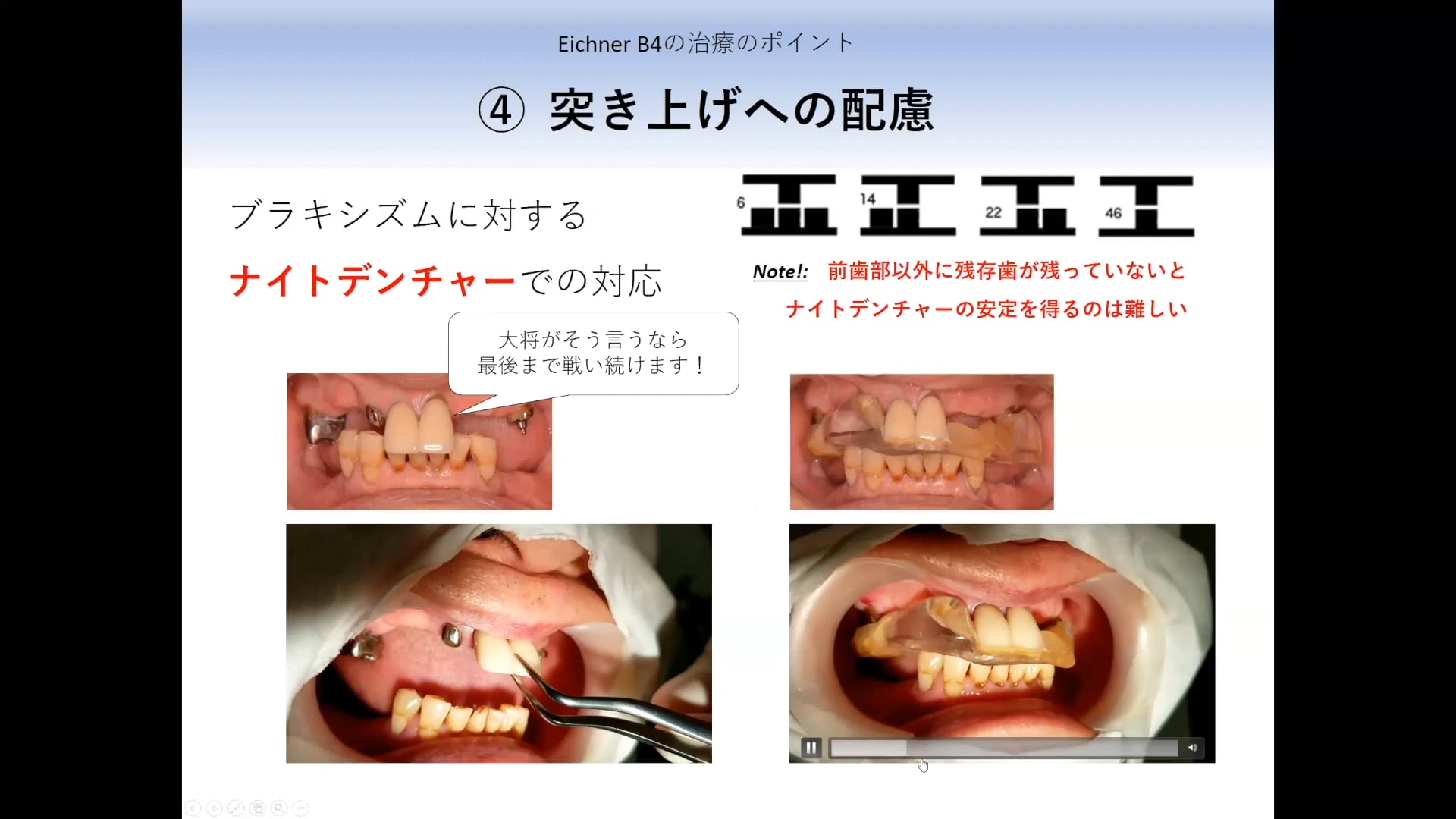 #2 Denture Cafe第15回 「すれ違い一歩手前！？」アイヒナーB4症例の声を聞いてみる