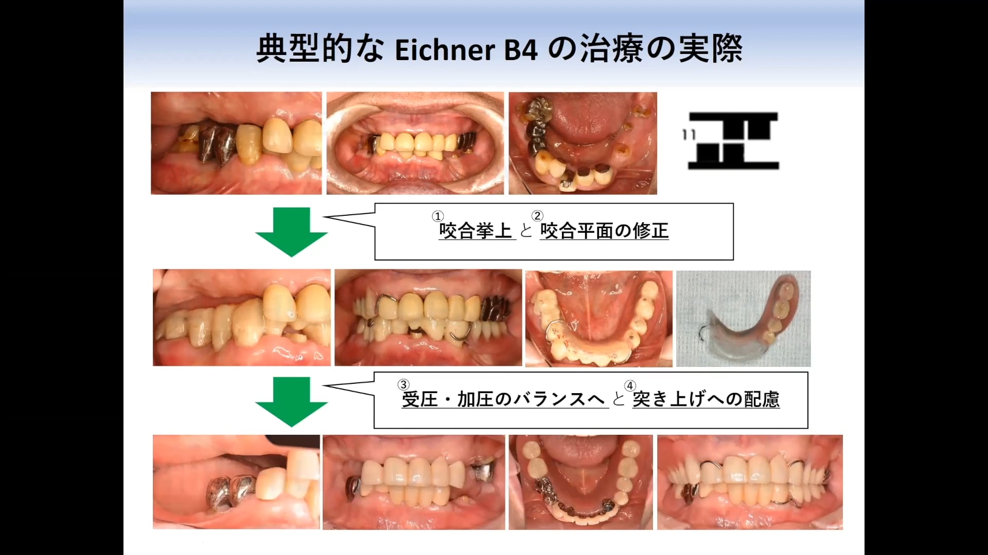 #1 Denture Cafe第15回 「すれ違い一歩手前！？」アイヒナーB4症例の声を聞いてみる