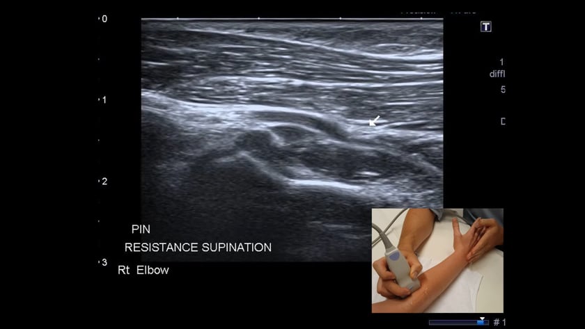 Elbow pathology – ULTRASOUNDPAEDIA