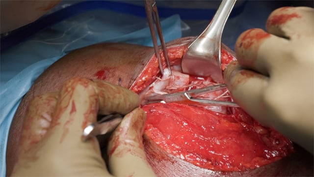 Surgical Repair of Distal Rectus Femoris Myotendinous Rupture