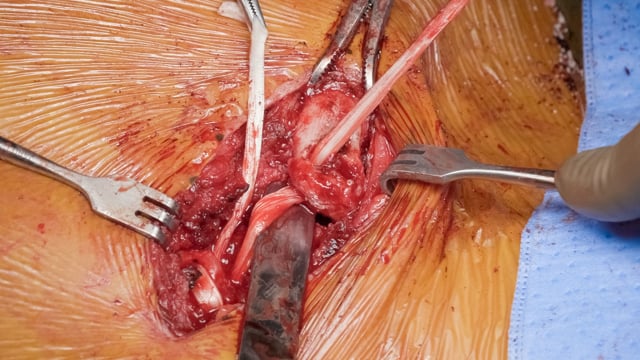SC Joint Reconstruction for Medial Clavicle Fracture Nonunion