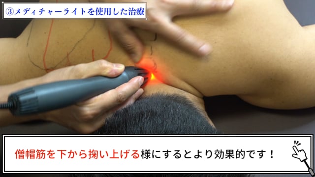 首痛治療