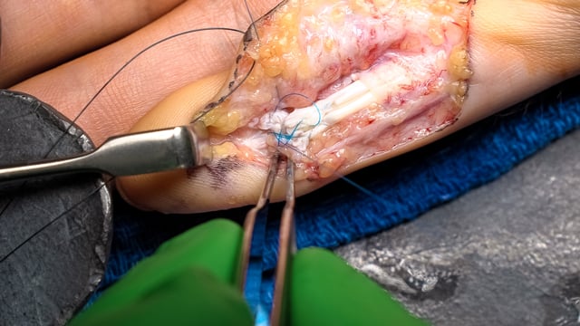 Zone I Flexor Tendon Repair Techniques and Outcomes