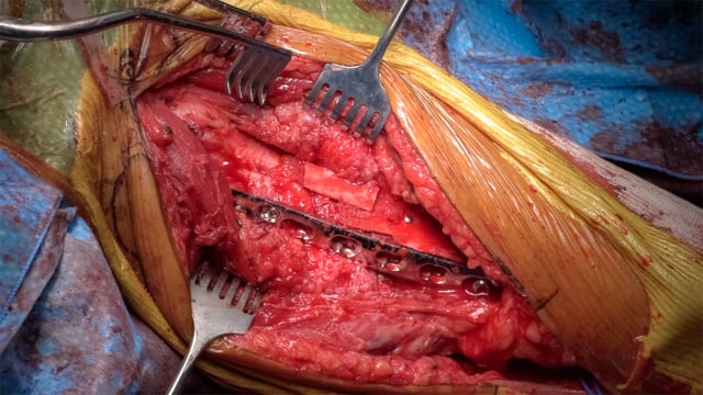 Repair of Humeral Shaft Nonunion with Plate and Screw Fixation and Iliac Crest Bone Graft