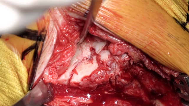 Staged Reconstruction of a Moore Type 4 Tibial Plateau Fracture Dislocation – PLC  Reconstruction & ACL Reconstruction with Quadriceps Tendon Autograft