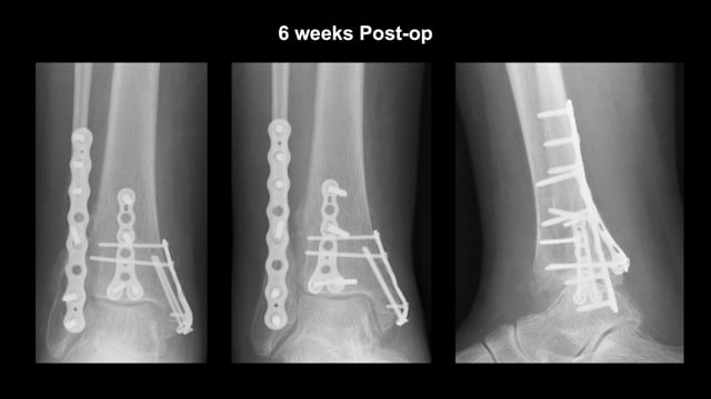 Posterolateral Approach for Trimalleolar Ankle Fracture