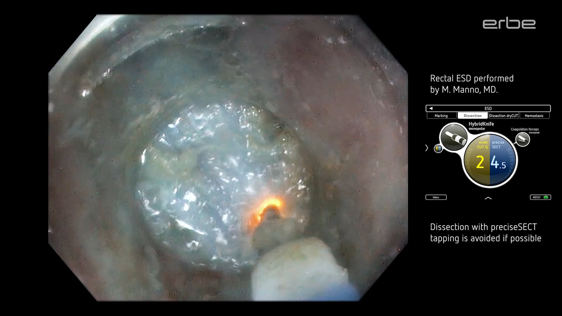 Rectal ESD procedure using VIO® 3 preciseSECT mode with HybridKnife®