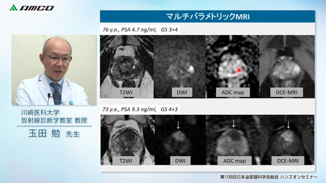 前立腺癌診療におけるガイド下前立腺標的生検のインパクト