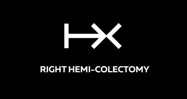 Right hemicolectomy