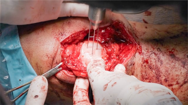 Bipolar Osteochondral Allograft Transplantation with Shell Patella and Revision MPFL Reconstruction Using Quadriceps Autograft