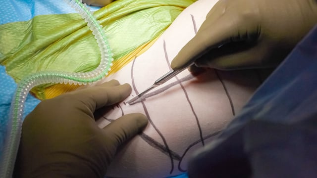 Minimally Invasive Suture Button Repair of Displaced Lesser Trochanter Fracture in an Adolescent Elite Ballerina