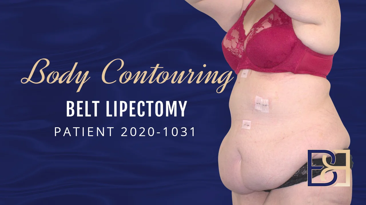 Belt Lipectomy Surgery After Weight Loss on Vimeo