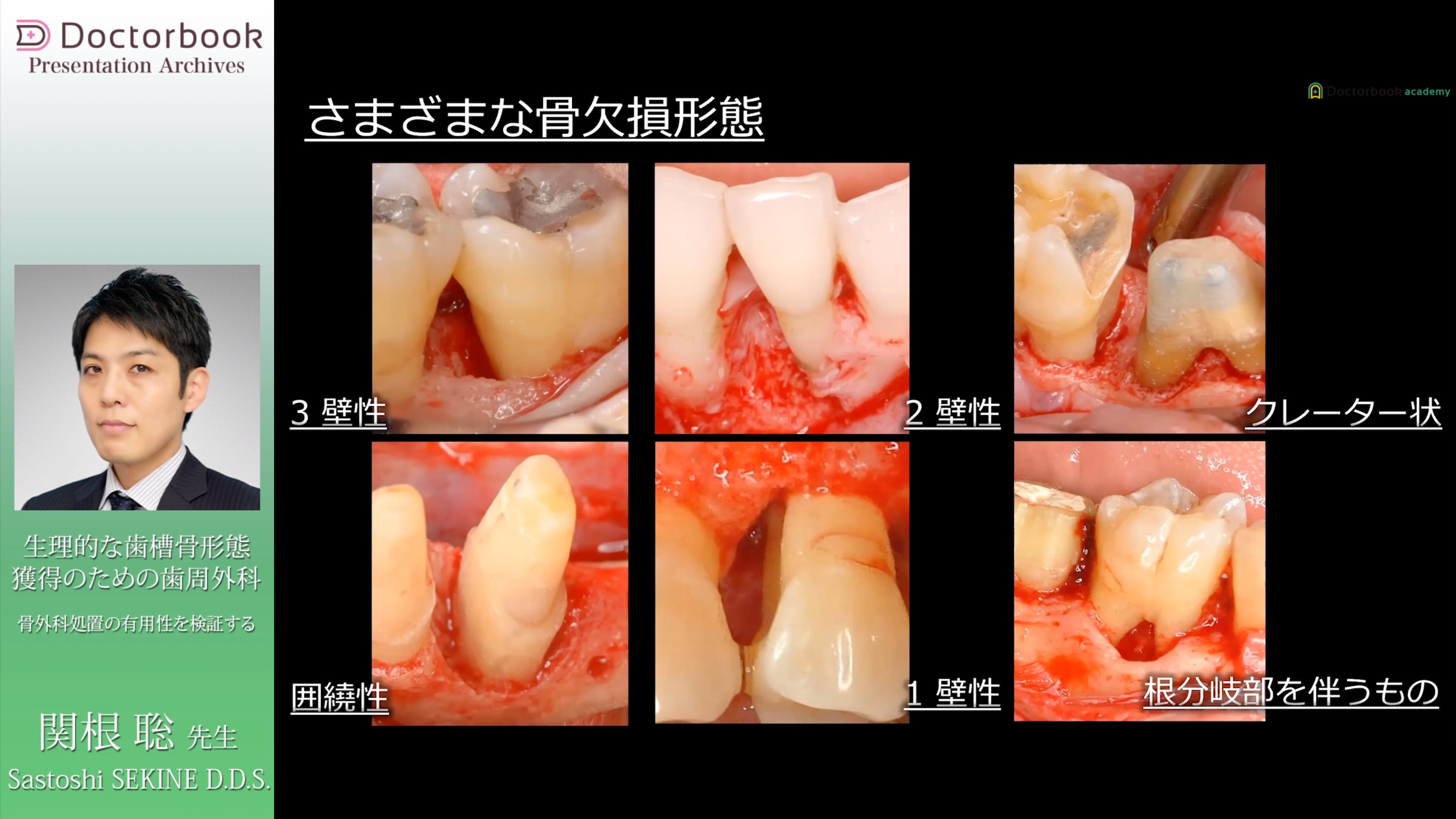 ＃1 正常な歯周組織と病的な歯周組織