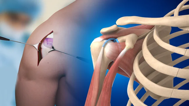 Acromioclavicular (AC) Joint Osteoarthritis Video