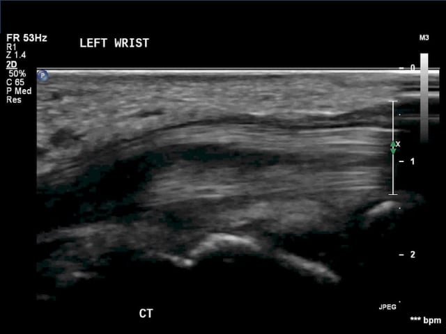 Wrist pathology – ULTRASOUNDPAEDIA