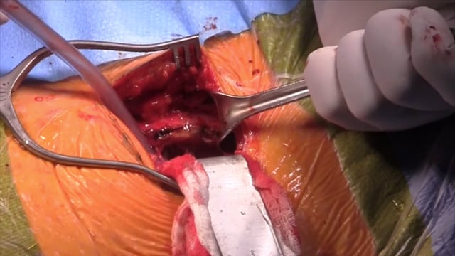 Posteromedial Approach to Tibial Plateau Fracture Nonunion