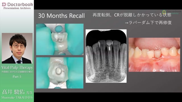 Vital Pulp Therapy 外傷歯における生活歯髄保存療法