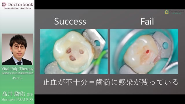 Vital Pulp Therapy 外傷歯における生活歯髄保存療法 | Doctorbook academy (ドクターブックアカデミー)