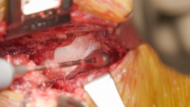 Mini-open Cam Resection for Femoroacetabular Impingement