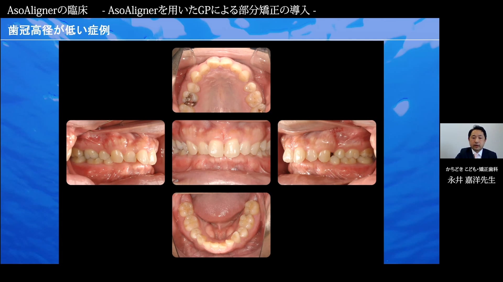 「ASOAlignerサティフィケートセミナー」AsoAlignerの臨床 - AsoAlignerを用いたGPによる部分矯正の導入 -